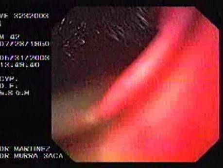 Hourglass Stomach - Constriction at the Proximal Gastric Corpus - Residuals of Blood in the Antrum
