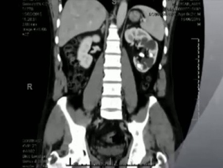 RIRS - Laser Lithotripsy Multiple Stones of Lower Moeity of Duplicated Pelvis