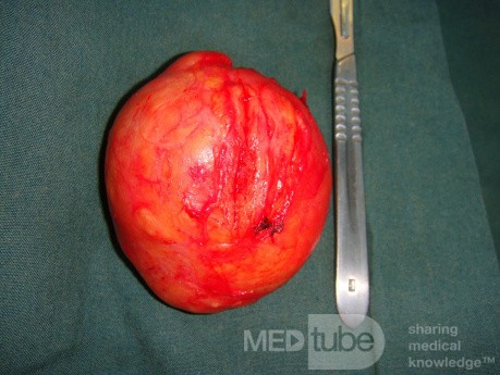 Lipoma in the posterior aspect of the neck- after removal