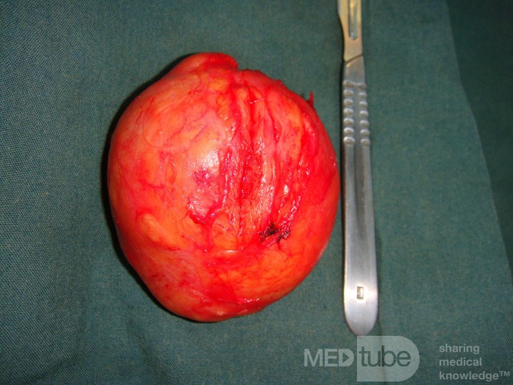 Lipoma in the posterior aspect of the neck- after removal