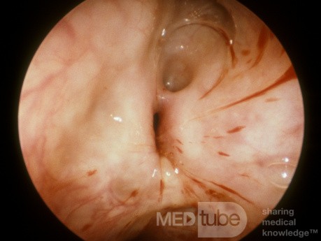 Natural Maxillary Sinus Ostium As Seen From Inside The Maxillary Sinus