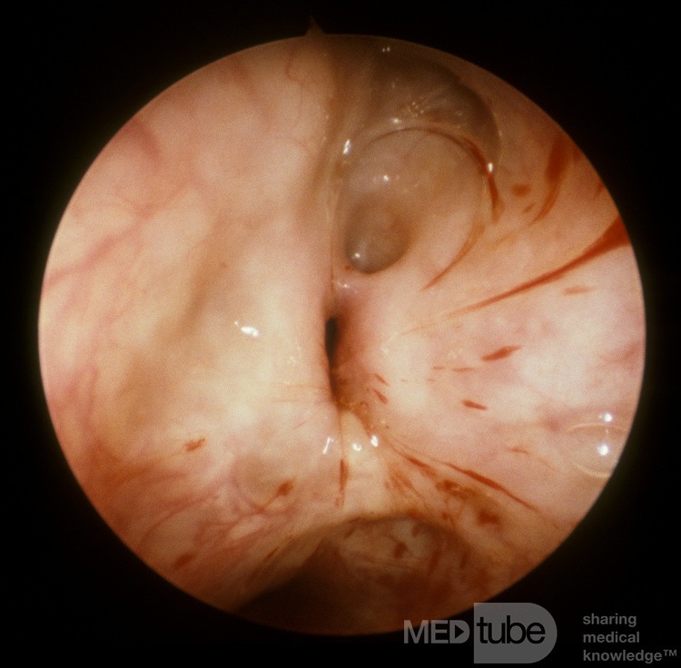 Natural Maxillary Sinus Ostium As Seen From Inside The Maxillary Sinus