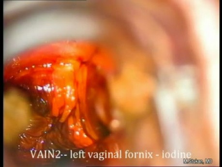 Colposcopy of Vagina