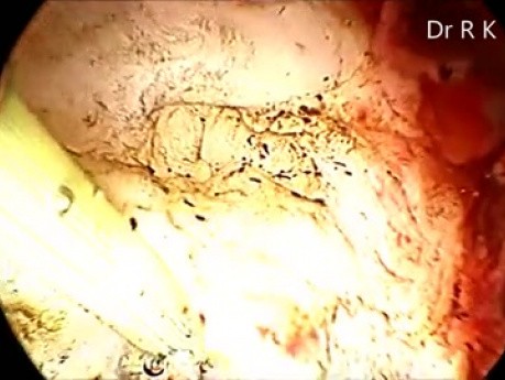 Hysteroscopic Myomectomy