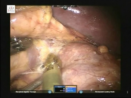 Robotic Left Adrenalectomy