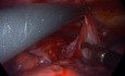 Mediastinal Bronchogenic Cyst in a 10 yr old Boy