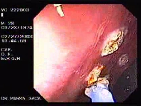 Familial Adenomatous Polyposis of the Colon (24 of 29)