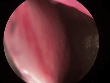 Endoscopic Septoplasty 