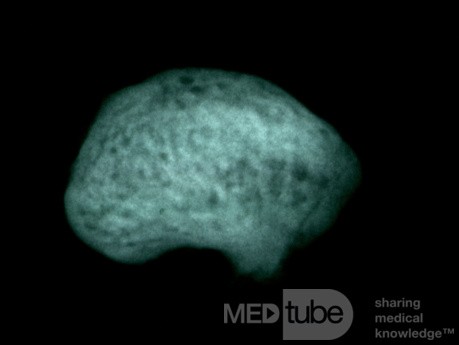 Osteoma Ear Canal [microradiograph]
