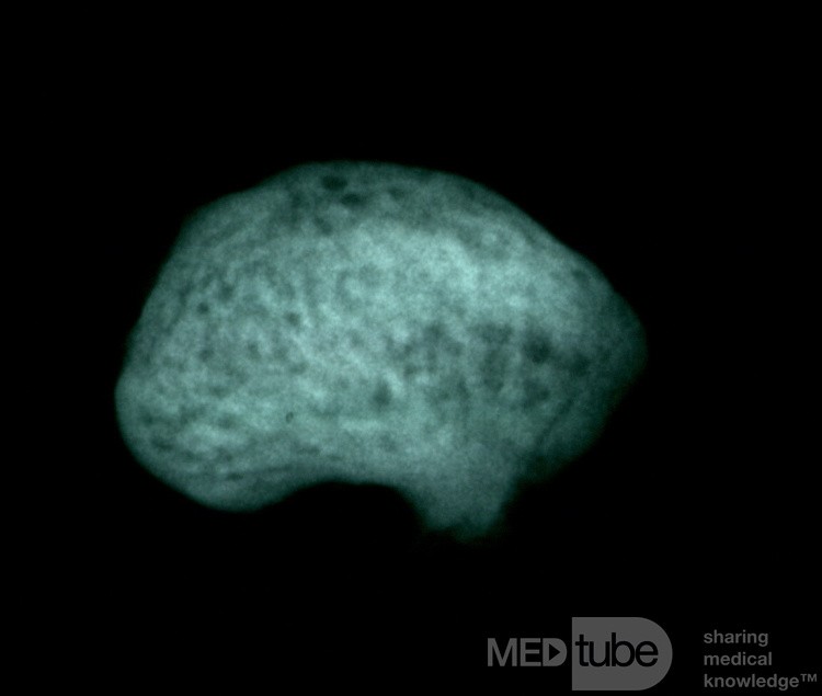 Osteoma Ear Canal [microradiograph]