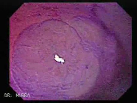 Flat Adenoma (2 of 3)