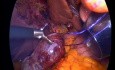 Laparoscopic Cholecystectomy (Fundus-First Technique)