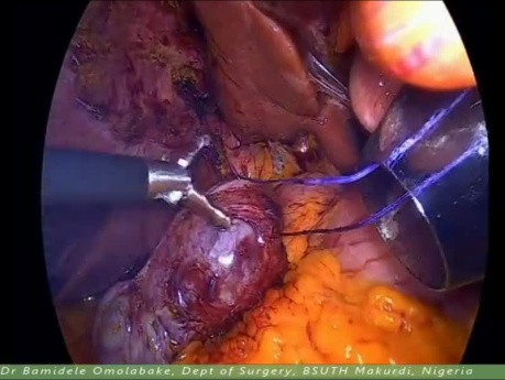 Laparoscopic Cholecystectomy (Fundus-First Technique)