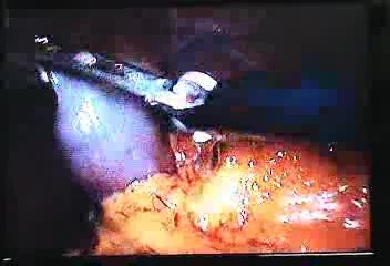 Jejunal Gastrointestinal Stromal tumor (GIST) (83 of 86)