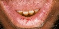 Osler Weber Rendu Disease Lips