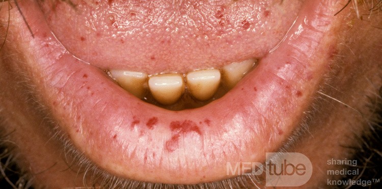 Osler Weber Rendu Disease Lips