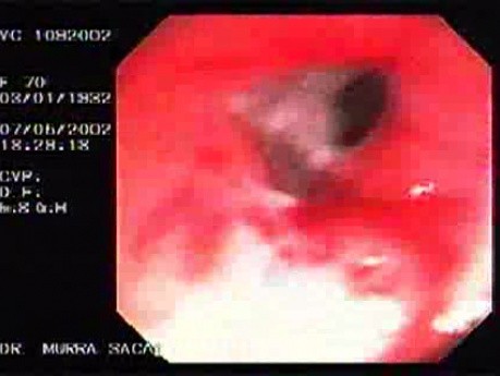 Recto-vaginal Fistula (2 of 3)