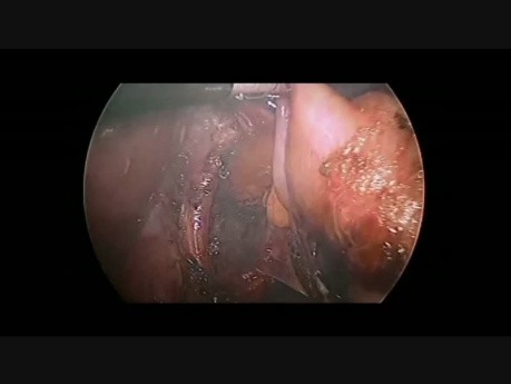 Laparoscopic Redo Nissen Fundoplication in 17-month Old Child
