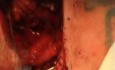 Tracheoesophageal fistula