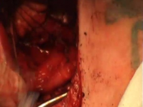 Tracheoesophageal fistula
