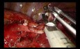 Uniportal VATS S1+S2+S6 Enbloc Anatomic Segmentectomy