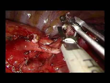 Uniportal VATS S1+S2+S6 Enbloc Anatomic Segmentectomy