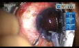 Cataract Surgery with Posterior Capsulorrhexis Rescue