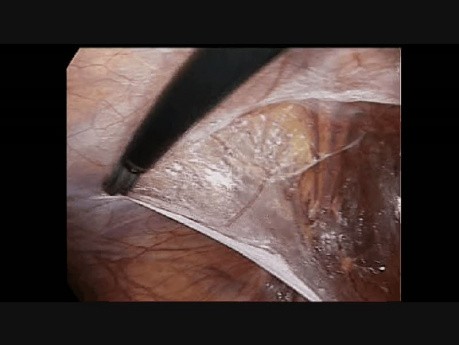 Laparoscopic Groin Hernia Repair Step 3: Left Peritoneal Incision