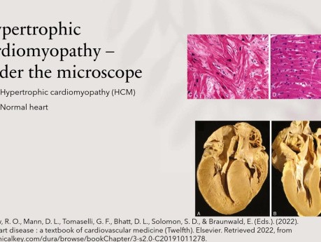 Echocardiography and Multimodality Cardiovascular Imaging in Hypertrophic Cardiomyopathy 2022 Update