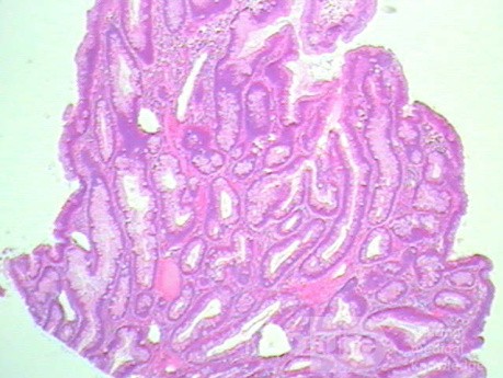 Tubulo - Villous Rectal Adenoma - Endoscopy (26 of 35)