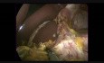 Laparoscopic Roux en Y D2 Subtotal Gastrectomy