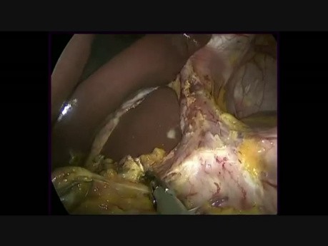 Laparoscopic Roux en Y D2 Subtotal Gastrectomy