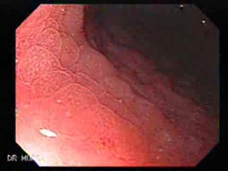 Follicular Lymphoid Hyperplasia (1 of 4)