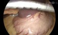 Laparoscopic Hiatal Hernia Repair with Toupet Fundoplication 