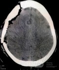 Acute Spontaneous Subdural Hemorrhage in the Subdural Space