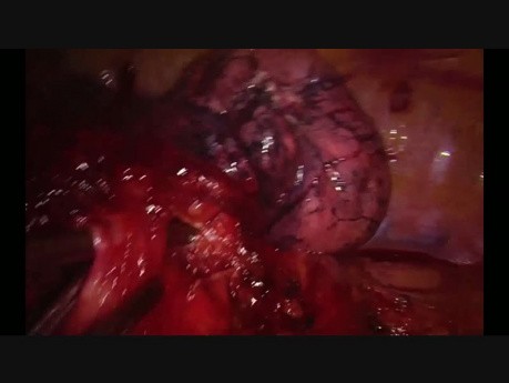 Right Upper Lobectomy by Using Curved Tip 5 mm Stapler