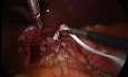 Laparoscopic surgery of hiatus hernia