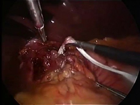 Laparoscopic surgery of hiatus hernia