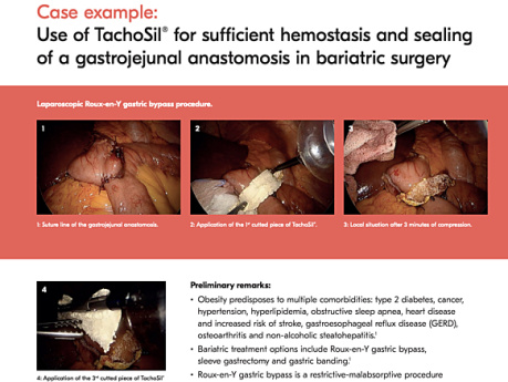 Use of TachoSil® in Bariatric Surgery for Sufficient Haemostasis and Sealing in MIS Roux-en Y Gastric Bypass Procedure