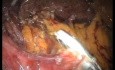 Laparo-Endoscopic Single Site (LESS) Morgagni Hernia Repair and Toupet Fundoplication