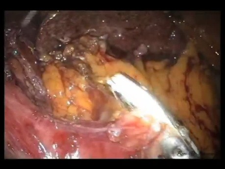 Laparo-Endoscopic Single Site (LESS) Morgagni Hernia Repair and Toupet Fundoplication