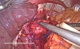 Laparoscopic Nissen Fundoplication