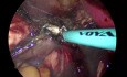 vNOTES Hysterectomy for Endometrial Hyperplasia
