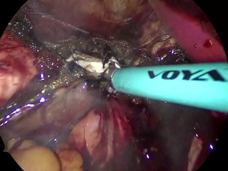 vNOTES Hysterectomy for Endometrial Hyperplasia