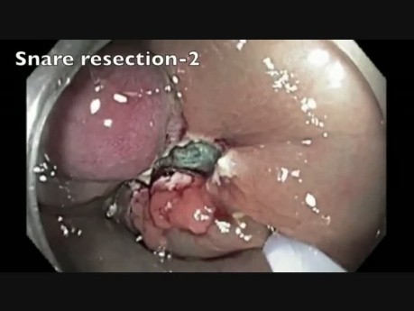 Colon EMR Perforation Analysis-E