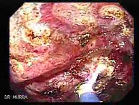 Post-Radiation Colitis (8 of 13)