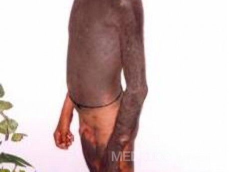 Hyperpigmentation Of The Skin - Other Shot