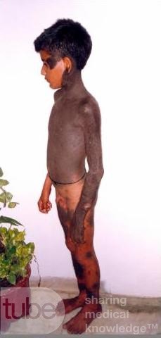 Hyperpigmentation Of The Skin - Other Shot