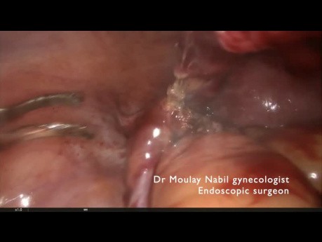 Emergency salpingectomy for ruptured ectopic pregnancy