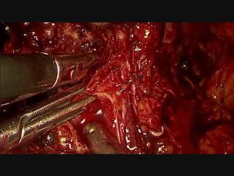 Laparoscopic Radical Prostatectomy